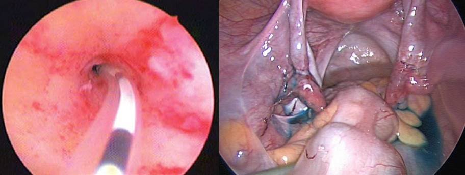 Bilateral Fallopian Tubal block