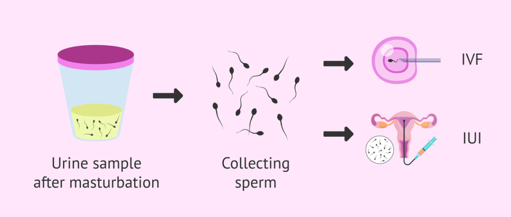 Case of Retrograde Ejaculation